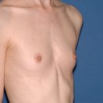 Breast Implants - Breast Augmentation Before & After Patient #1134