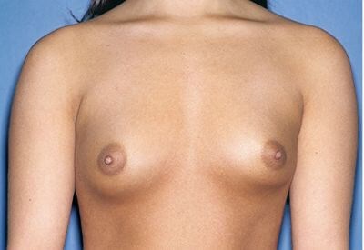 Breast Implants - Breast Augmentation Before & After Patient #1109