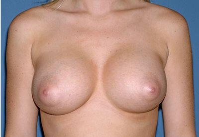 Breast Implants - Breast Augmentation Before & After Patient #1101