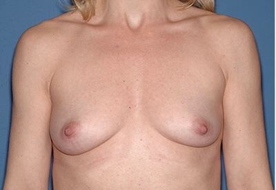 Breast Implants - Breast Augmentation Before & After Patient #1066