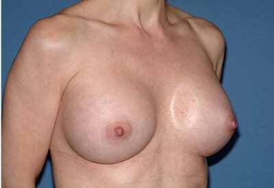Breast Implants - Breast Augmentation Before & After Patient #1066