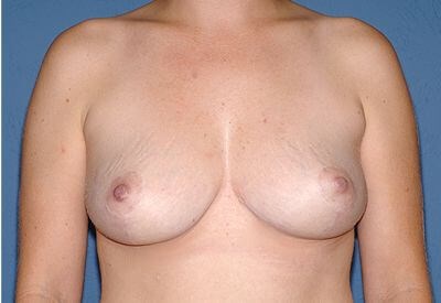 Breast Lift - Mastopexy Before & After Patient #1348