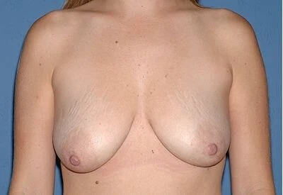 Breast Lift - Mastopexy Before & After Patient #1348
