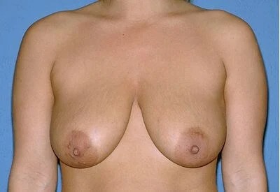 Breast Lift - Mastopexy Before & After Patient #1341