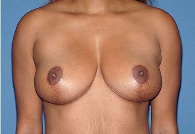Breast Lift - Mastopexy Before & After Patient #1334