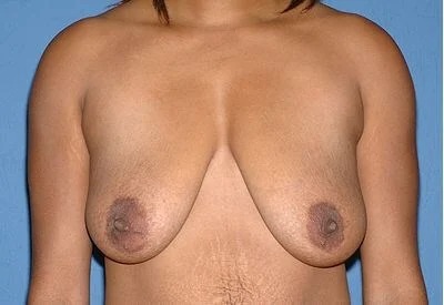 Breast Lift - Mastopexy Before & After Patient #1334