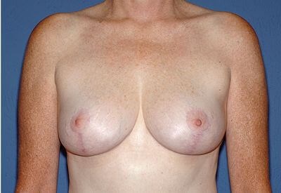 Breast Lift - Mastopexy Before & After Patient #1327