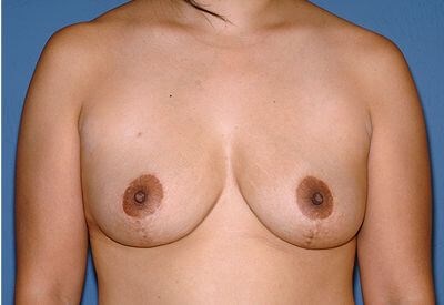 Breast Lift - Mastopexy Before & After Patient #1306