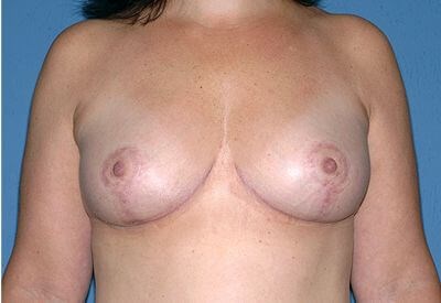 Breast Lift - Mastopexy Before & After Patient #1320