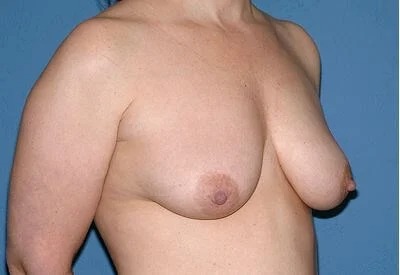 Breast Lift - Mastopexy Before & After Patient #1320