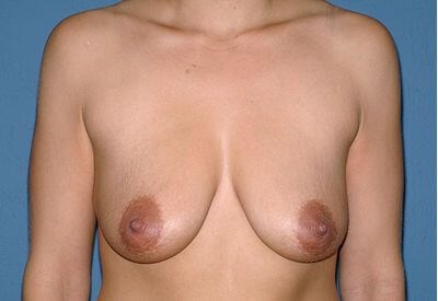 Breast Lift - Mastopexy Before & After Patient #1291
