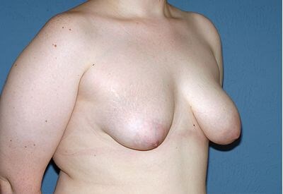 Breast Lift - Mastopexy Before & After Patient #1284