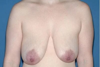 Breast Lift - Mastopexy Before & After Patient #1277