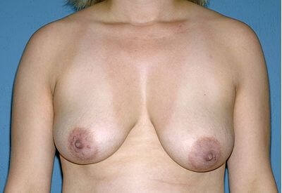 Breast Lift - Mastopexy Before & After Patient #1269