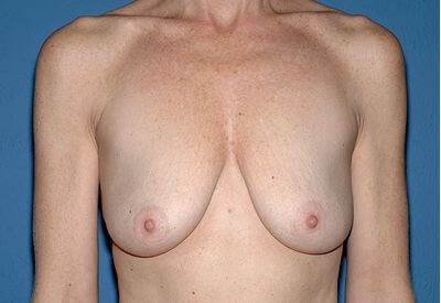 Breast Lift - Mastopexy Before & After Patient #1262