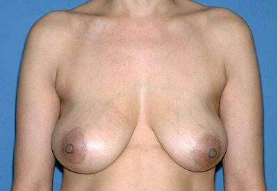 Breast Lift - Mastopexy Before & After Patient #1255