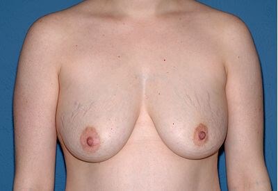 Breast Lift - Mastopexy Before & After Patient #1239