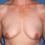 Breast Lift - Mastopexy Before & After Patient #1363