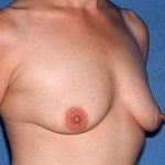 Breast Lift - Mastopexy Before & After Patient #1363