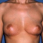 Breast Lift - Mastopexy Before & After Patient #1356