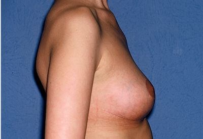 Breast Lift - Mastopexy Before & After Patient #1356