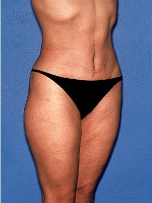 Liposuction - Body Before & After Patient #664