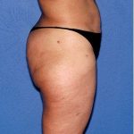 Liposuction - Body Before & After Patient #664
