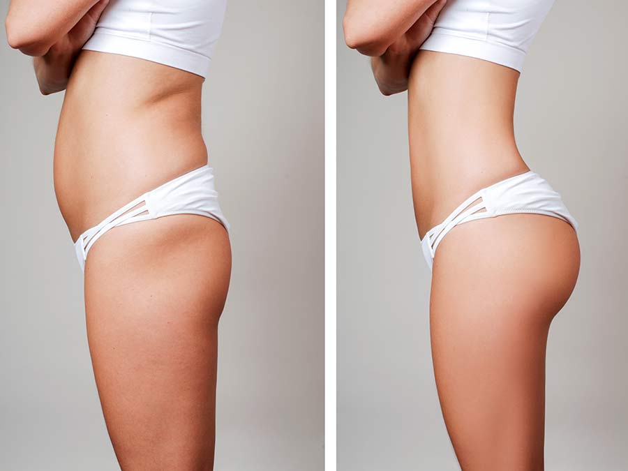 Liposuction before and after look.  Dr. Steven White.  USA Plastic Surgery.