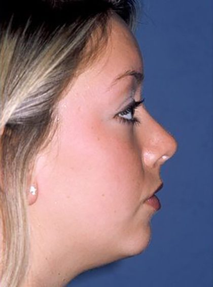 Nose Surgery - Rhinoplasty - Primary Before & After Patient #173