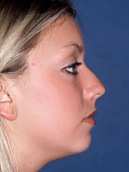 Nose Surgery - Rhinoplasty - Primary Before & After Patient #173