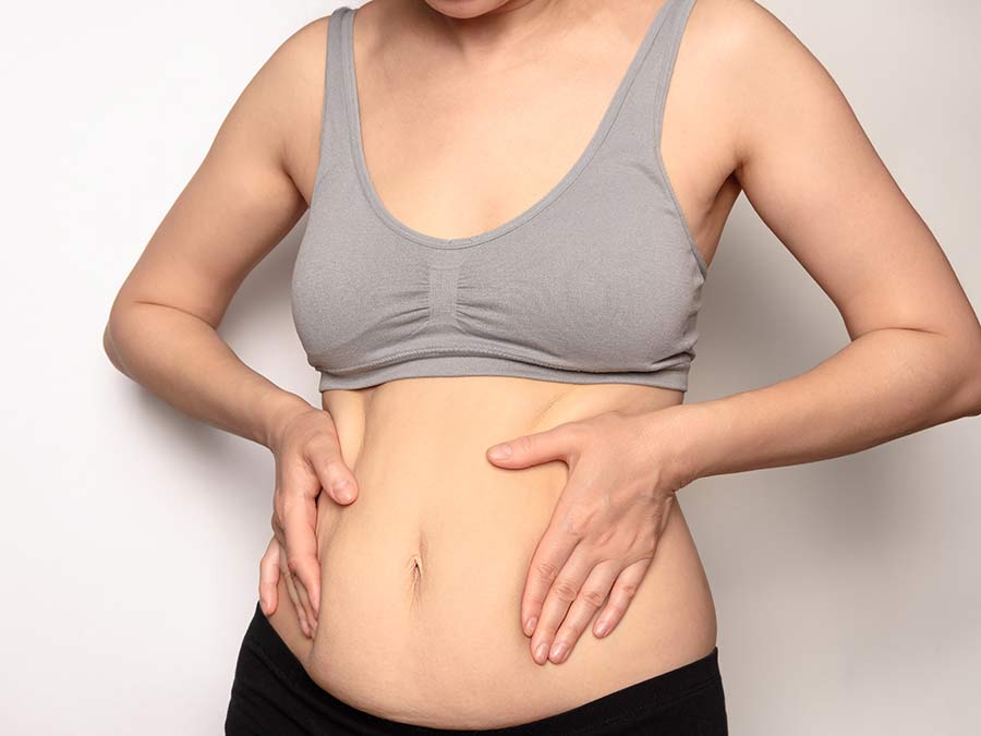 Woman considering Tummy Tuck procedure.  Dr. Steven White. USA Plastic Surgery.