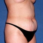 Tummy Tuck - Abdominoplasty Before & After Patient #275