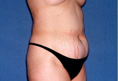 Tummy Tuck - Abdominoplasty Before & After Patient #275