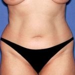 Tummy Tuck - Abdominoplasty Before & After Patient #403