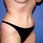 Tummy Tuck - Abdominoplasty Before & After Patient #403