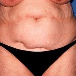 Tummy Tuck - Abdominoplasty Before & After Patient #342
