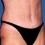 Tummy Tuck - Abdominoplasty Before & After Patient #342