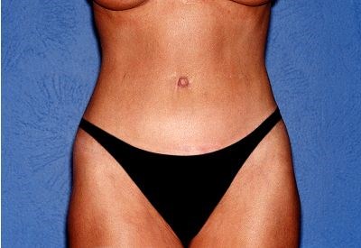 Tummy Tuck - Abdominoplasty Before & After Patient #468