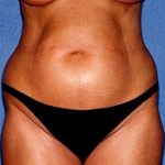 Tummy Tuck - Abdominoplasty Before & After Patient #468