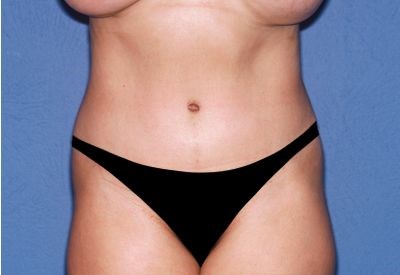 Tummy Tuck - Abdominoplasty Before & After Patient #454