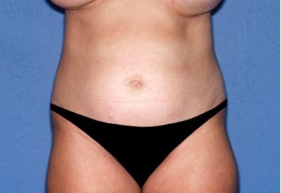 Tummy Tuck - Abdominoplasty Before & After Patient #454