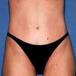 Tummy Tuck - Abdominoplasty Before & After Patient #436