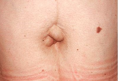 Tummy Tuck - Abdominoplasty Before & After Patient #436