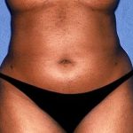 Tummy Tuck - Abdominoplasty Before & After Patient #412