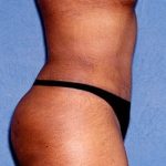 Tummy Tuck - Abdominoplasty Before & After Patient #412