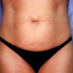 Tummy Tuck - Abdominoplasty Before & After Patient #392