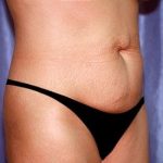 Tummy Tuck - Abdominoplasty Before & After Patient #392