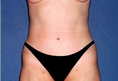 Tummy Tuck - Abdominoplasty Before & After Patient #316