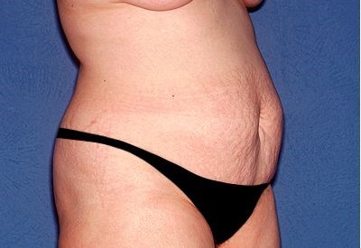 Tummy Tuck - Abdominoplasty Before & After Patient #316