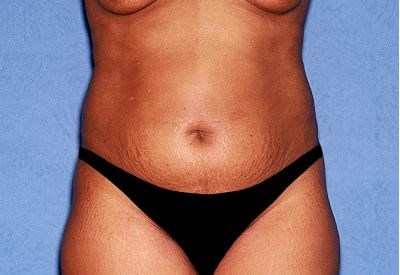 Tummy Tuck - Abdominoplasty Before & After Patient #293